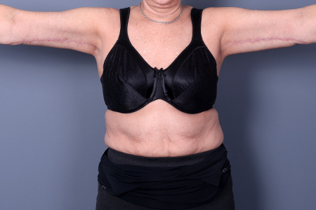 Arm Lift Patient 14