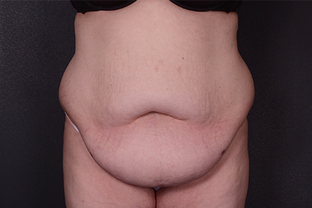 Tummy Tuck Patient 65