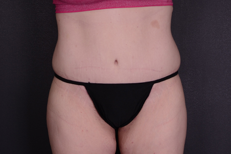 Tummy Tuck Patient 65