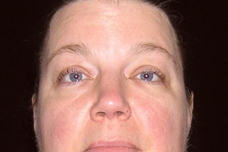 Eyelid Lift Patient 6